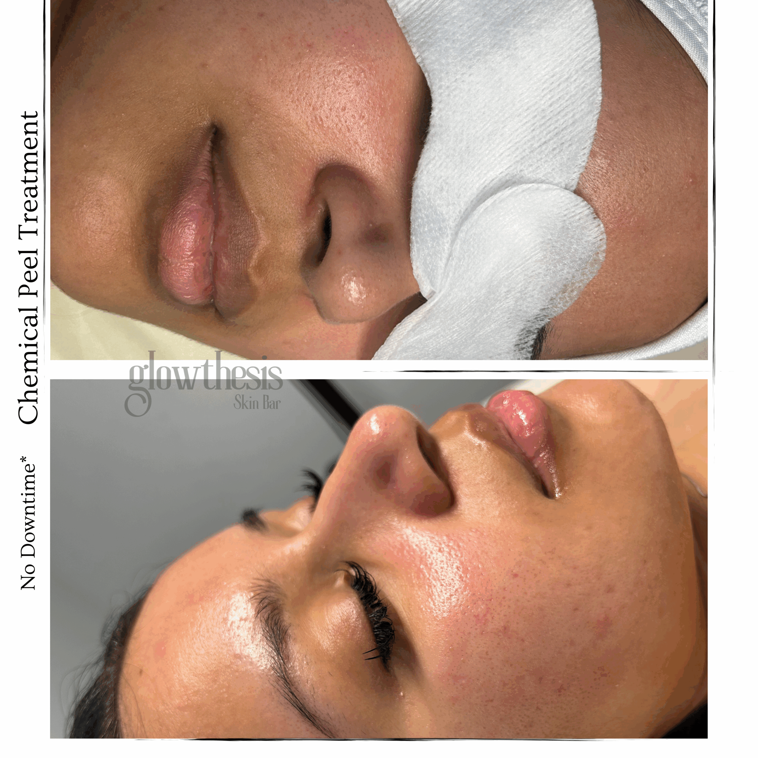 Chemical Peel Treatment