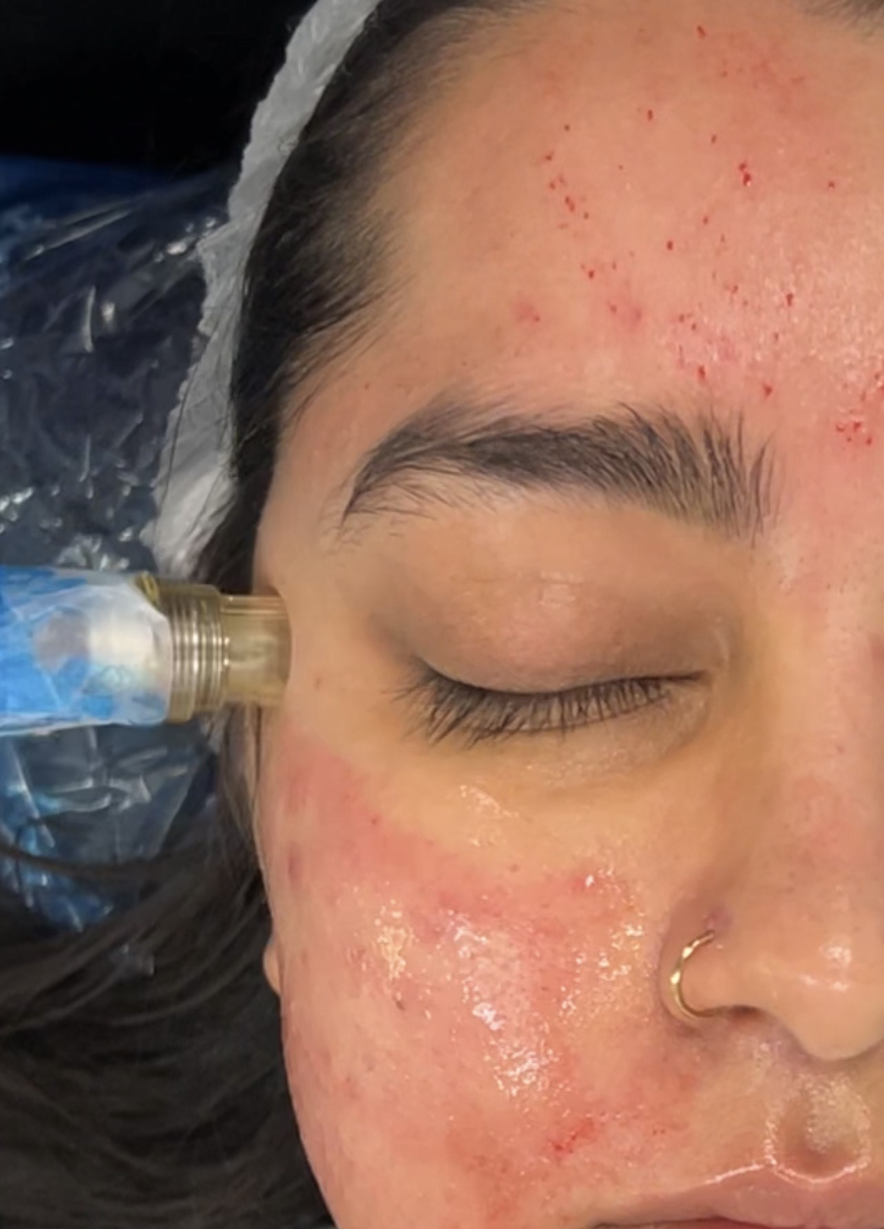 Protected: Microneedling Training (collagen induction therapy)*